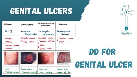 ; Less common infections such as chancroid, granuloma inguinale, molluscum contagiosum, and syphilis may also cause sores. . Ulcers on vagina
